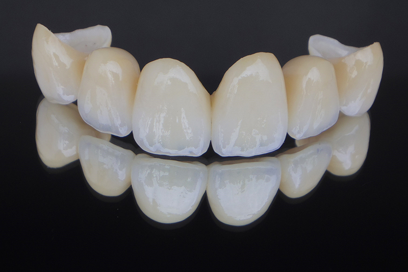 自由診療で選択肢を増やし、接着剤にもこだわる